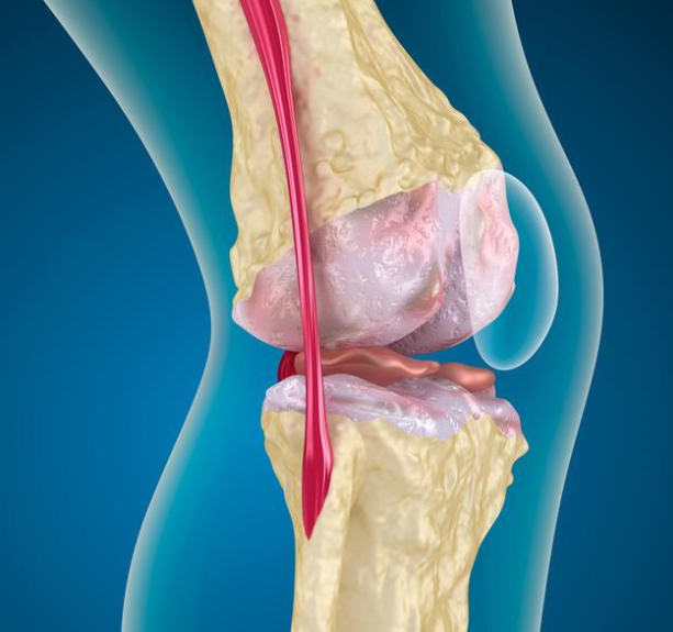 膝盖积水 要重视 四点 防水 建议要记牢 腾讯新闻