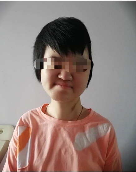 最终,经过多番检查会诊,世琳被确诊为普罗特斯综合症.