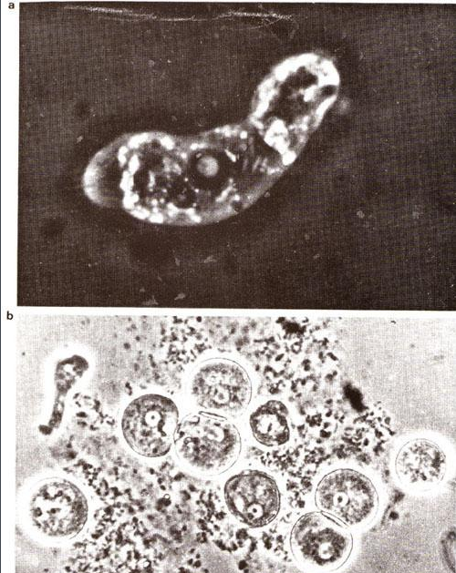 新冠|死亡率超97％！美国现食脑虫，感染症状类似新冠，发病14天内死亡