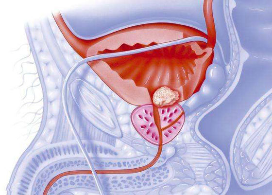 前列腺癌|研究人员开发了一种新技术，来理清前列腺癌细胞特有的复杂相互作用