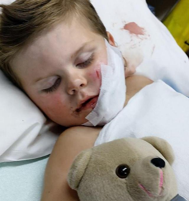 恶狗不牵绳澳大利亚2岁幼童被咬半边脸被撕开主人拒绝负责