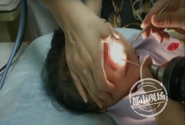 4岁女童鼻里塞珠子妈妈竟自己掏险些要了孩子的命