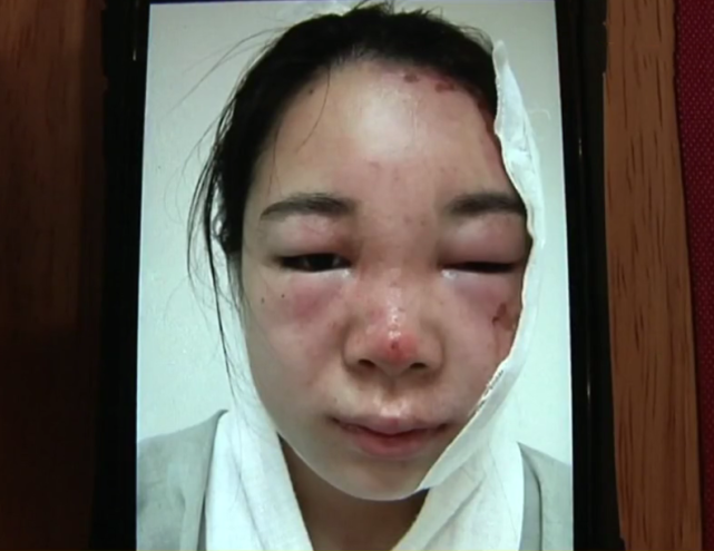 往榨汁机倒热水炸了她被烫得满脸水泡要求商家赔偿靠脸吃饭