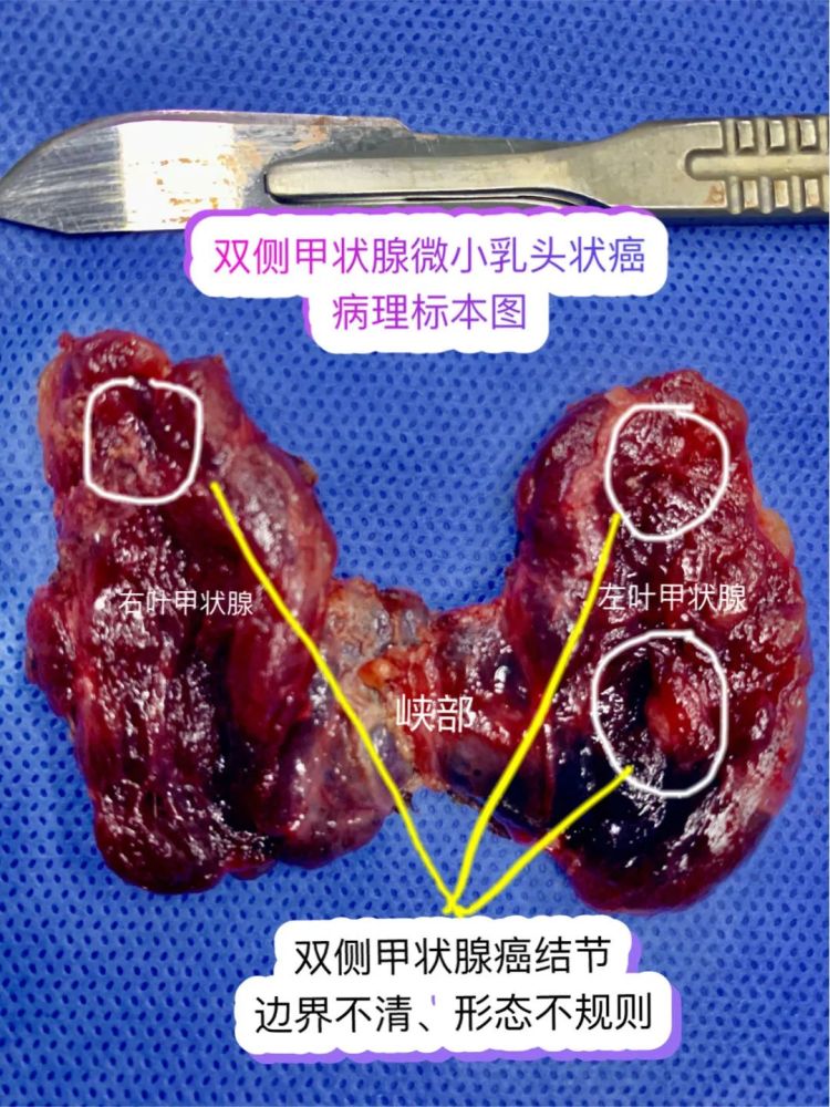 b超懷疑雙側甲狀腺結節惡性甲穿只提示一側惡性下一步怎麼辦