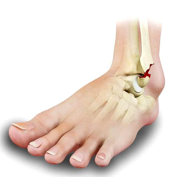 一般情况下脚踝骨折45天应该能走路了,但是我们也需要具体问题具体