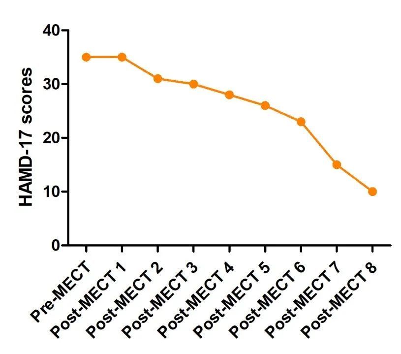 国内首例艾司氯胺酮mect治疗难治性抑郁症