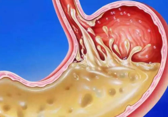 反流性食管炎伴胆汁反流:反酸半年,口干口苦,根治困难怎么办?_腾讯新