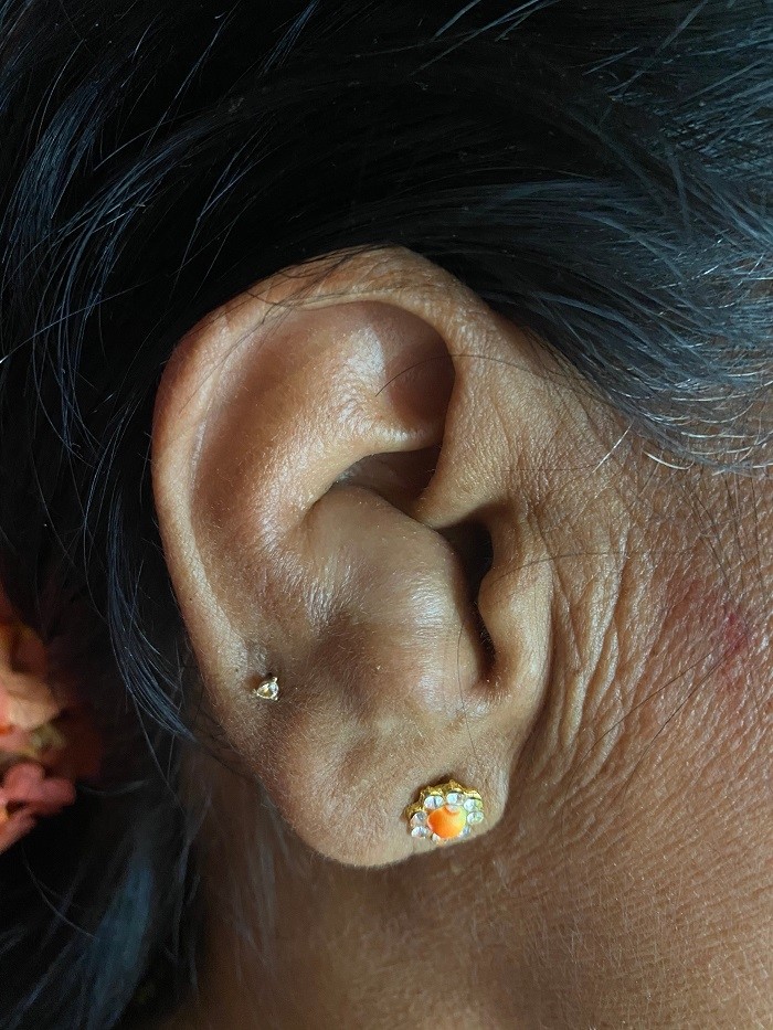 帅气的柔术运动员却长着肉肉的耳朵—"花椰菜耳",主要是由这一原因