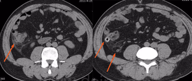 升結腸憩室並憩室炎升結腸憩室炎並穿孔硬化性腸繫膜炎為累及腸繫膜