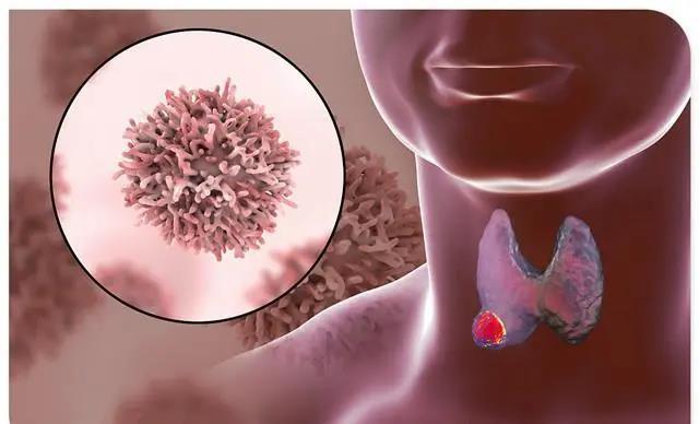 通經化濁消瘤甲狀腺癌的早期症狀是什麼其實並不難發現