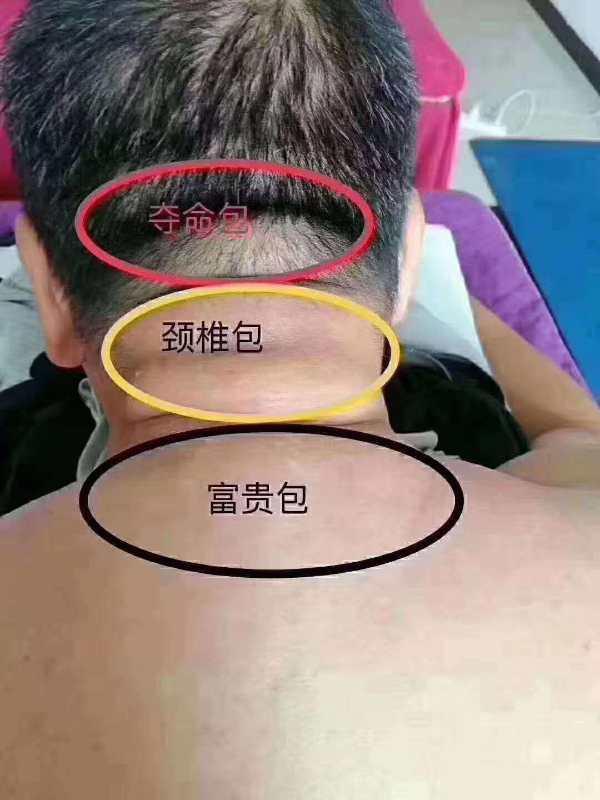 中医非遗传承人何传义富贵包不仅是一个包那么简单