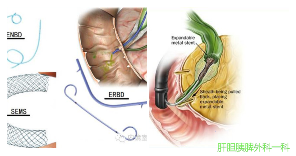 ct,mri和mrcp等)通常可确立诊断,内镜治疗胆管恶性狭窄的主要目的是