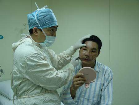 医学史上的传奇:中国换脸第一人,变不可能为可能