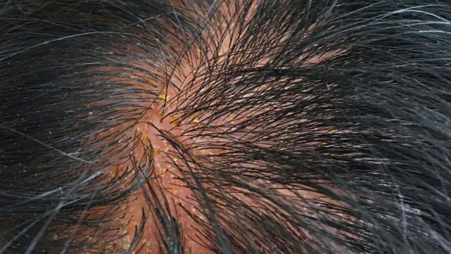 因为白发,自己在家染发后,几天后感觉头皮发痒,怀疑染发剂过敏剂过敏