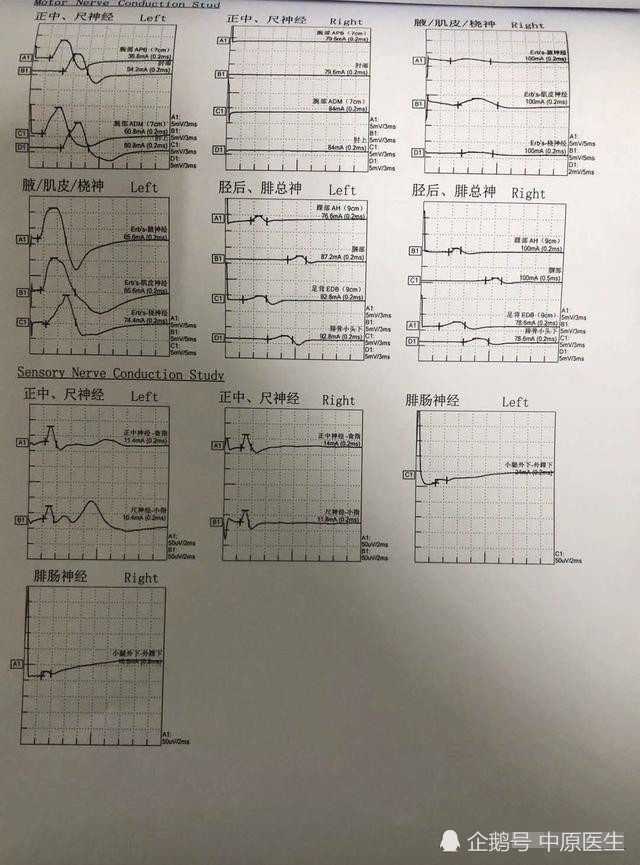 第2,3,4张图片:是患者于2018年6月在当地医院做的2次肌电图,均提示