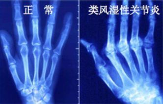 类风湿关节炎|引发类风湿经常发病的“罪魁祸首”不仅仅是吸烟？