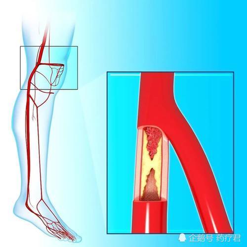腿痛腿麻腿抽筋医生不全是缺钙或是血管的求救信号