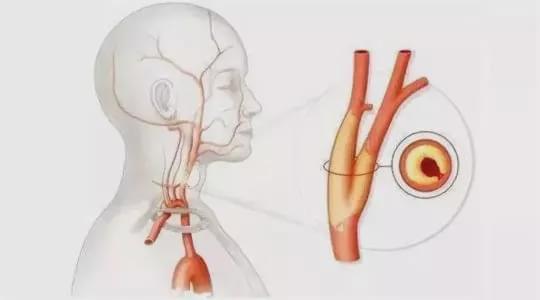 颈动脉斑块|60岁以上，几乎人人都有颈动脉斑块，出现这三个症状最危险！