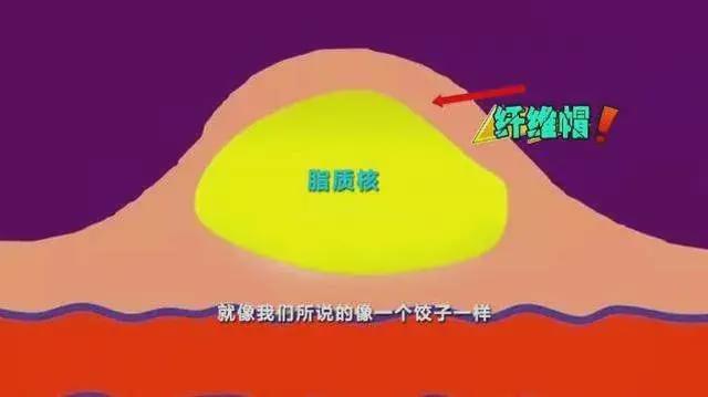 颈动脉斑块|60岁以上，几乎人人都有颈动脉斑块，出现这三个症状最危险！