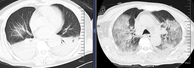 有趣病例雙肺瀰漫性病變肺水腫or肺部感染