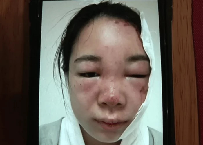 女子往榨汁机倒开水,结果爆炸导致脸部满脸水泡,索赔遭拒:这是常识