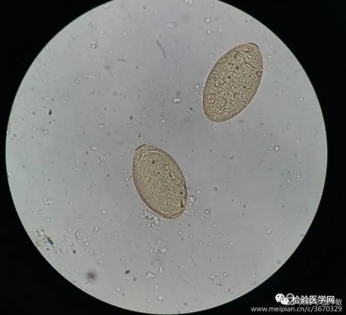 检验科医生还从我的粪便里找到了虫卵,长椭圆形,大小约127 μm × 90