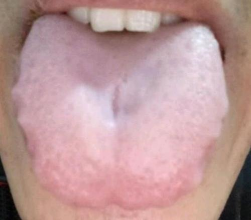 正常人的舌头两侧图片图片