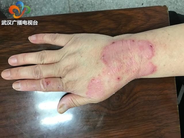 梅雨天淌水后爱抓脚女子脚气长到了手上