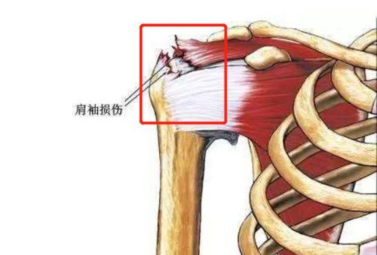肩膀痛抬不起来就是肩周炎乱治会弄坏肩关节正确做法有3个