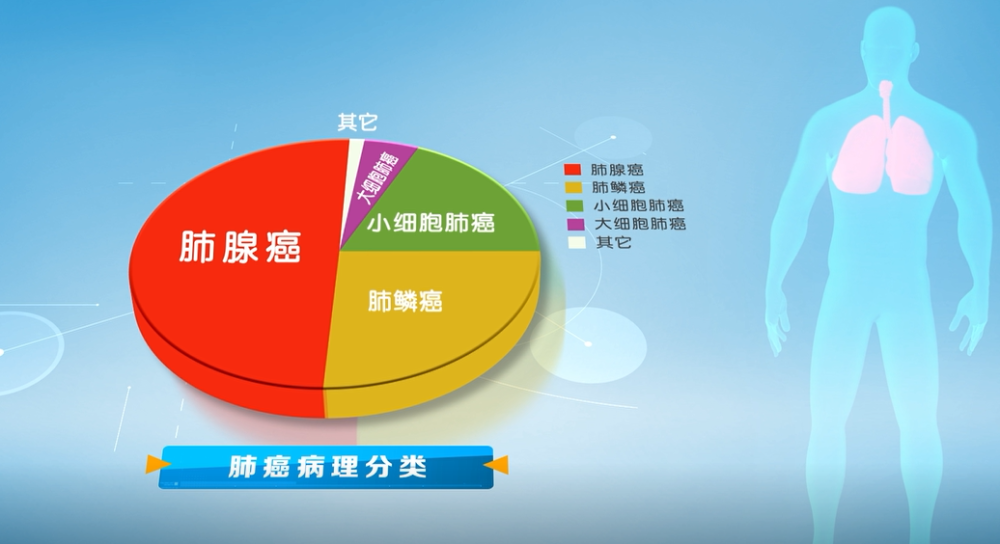 肺癌|为何不吸烟的女性得这种肺癌的比例上升？中国科学家发布“解秘”成果