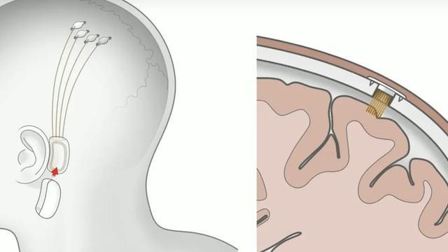 脑机接口|吊打上司，独占女神，马斯克说一年就将植入人脑的脑机接口有多神