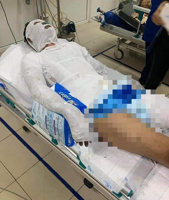 ngoc|男子和同事借钱没有按时还，对方一气之下浇汽油将其烧成重伤