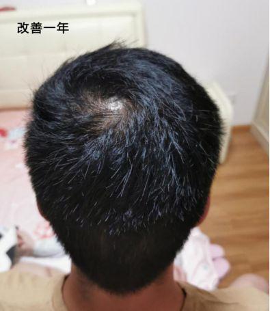 脱发区域,移植的毛囊不受雄 激素影响,植发后头发会自然生长,可以烫染