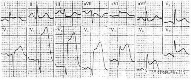 心電圖st段抬高還可能是這些病