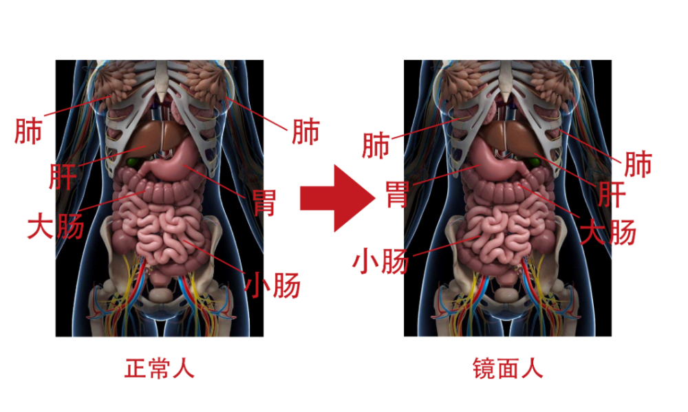 罕見江西一女子的內臟全長反了