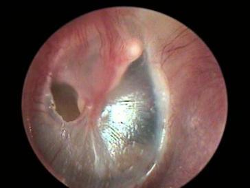 鼓膜穿孔|鼓膜穿孔有多严重？生活中注意这些保护好鼓膜