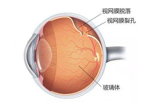 高度近视|高度近视，我可以和大家一起去献血吗？