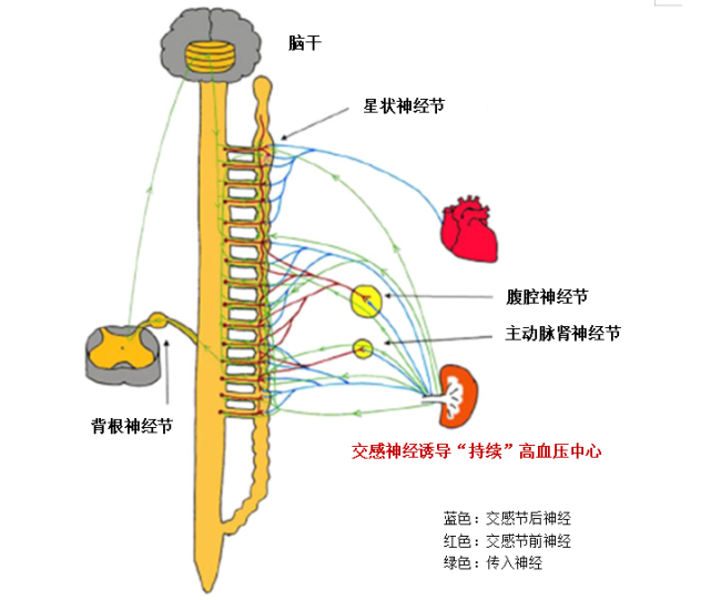 針對高血壓重要發病機制之一的交感神經過度興奮,腎去神經術 (renal