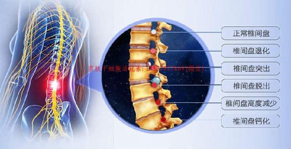 腰椎间盘膨出腰椎间盘突出与腰椎间盘脱出有什么区别