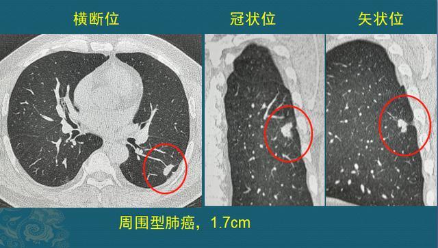 他胸口疼2年 肺癌才长到1 7cm 她被墙砸伤却查出晚期癌 腾讯新闻