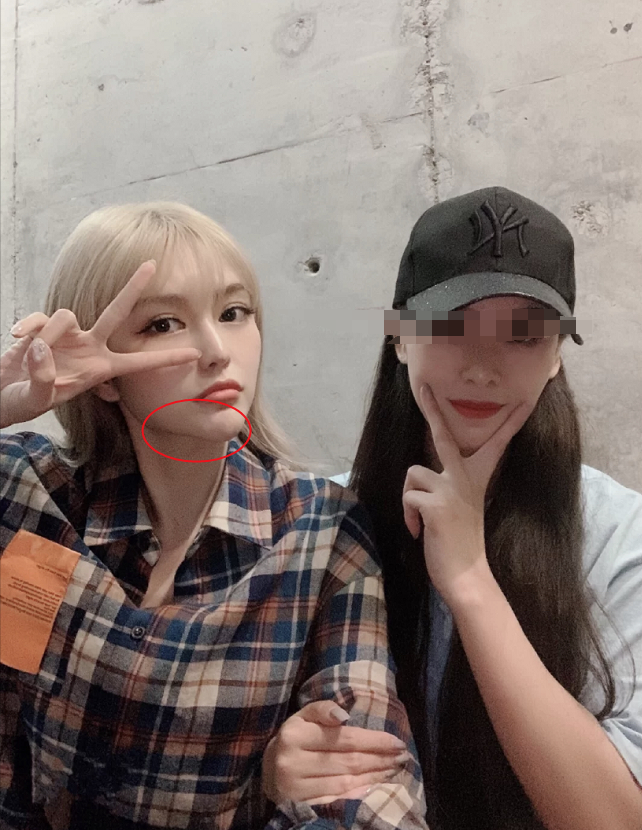 周扬青|网友偶遇周扬青与其合照，却暴露她整容后遗症，锥子脸极不自然