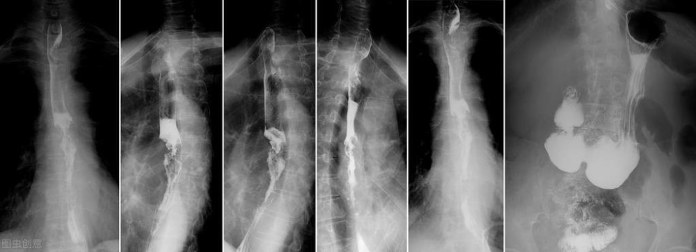 食管癌发病后身体有什么特征?如何预防?医生给您讲清楚