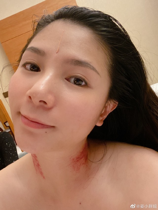 何姿放血排毒调理身体!额头手掌扎针看着都疼,脖子手臂留淤血