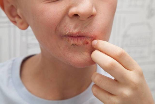 过敏性唇炎症状都有哪些?平时应该怎么注意?这些事情你需知道