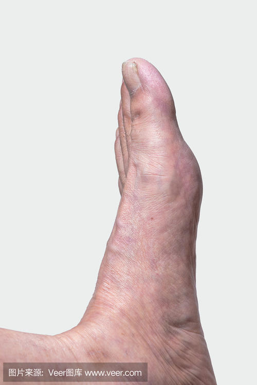 大脚趾出现疼痛到底是怎么回事
