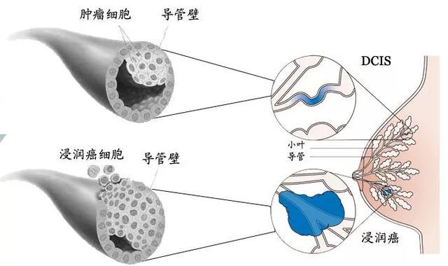 乳腺癌是从哪里起源的 腾讯新闻