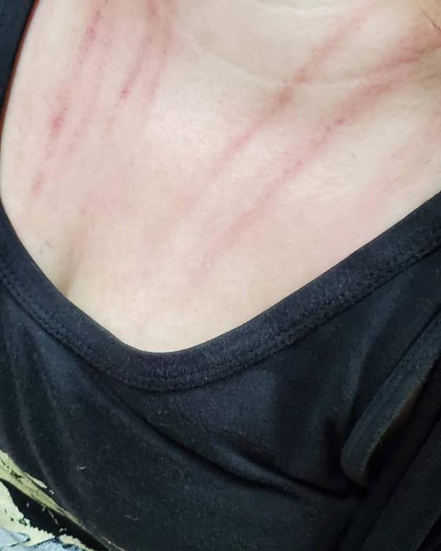 歌手称女友整容比妻子怀孕辛苦,与妻子庭外纠纷,抓伤红痕触目