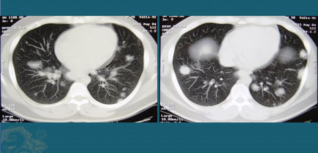 這病可引起肺結節和淋巴結腫大不是癌醫生說23會自愈