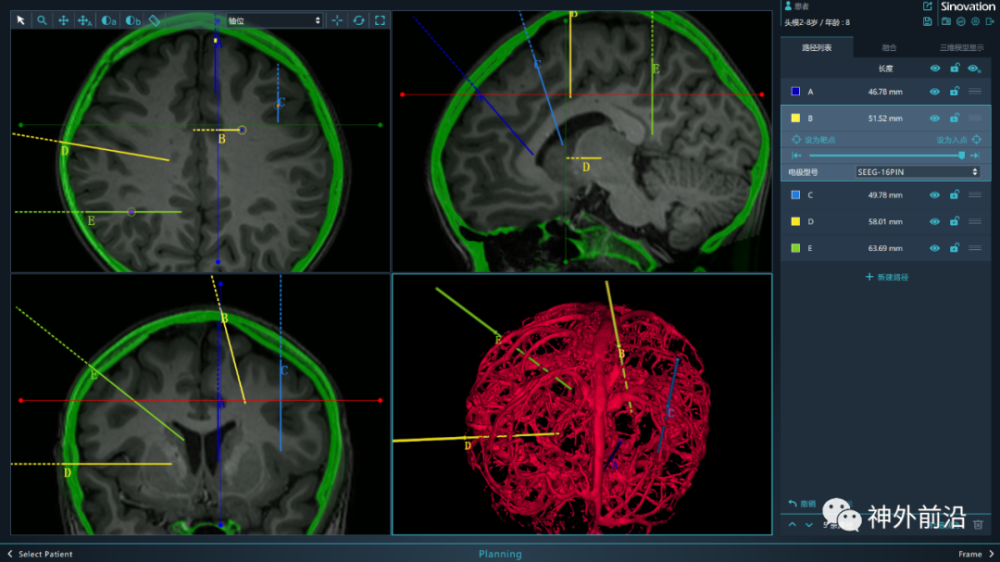 癫痫|儿童难治性癫痫的研究进展