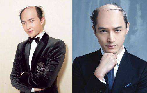 现在秃头的年轻人为什么越来越多呢的